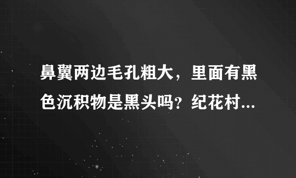 鼻翼两边毛孔粗大，里面有黑色沉积物是黑头吗？纪花村黑头终结套装效果怎么样？