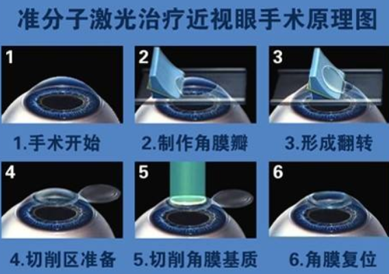 用激光打好近视眼有什么危害?