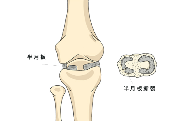 半月板损伤主要有哪些症状呢？