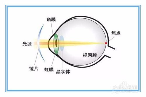 眼睛散光怎么恢复