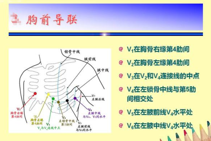 心电图导联如何连接