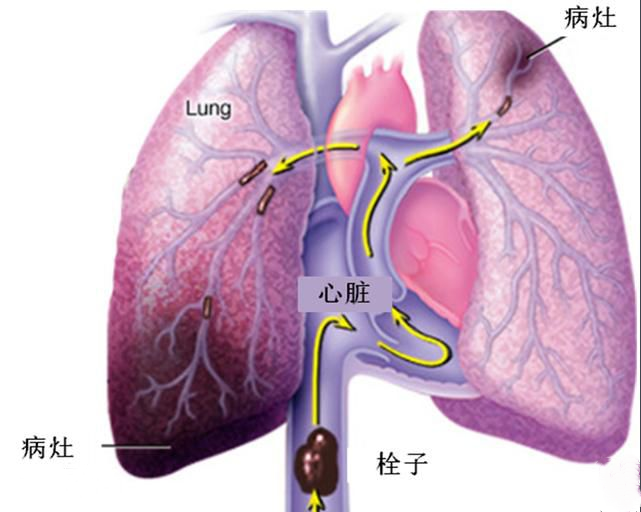 栓塞的名词解释