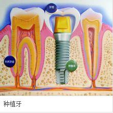 什么是人工种植牙