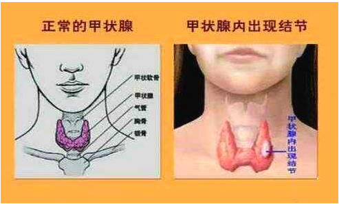 甲状腺结节是怎么回事