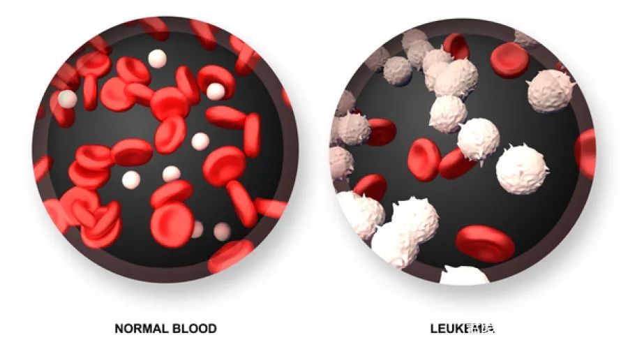 为什么会得白血病？