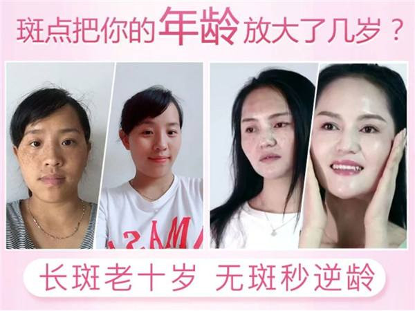 女人脸上有黄褐斑怎么去除