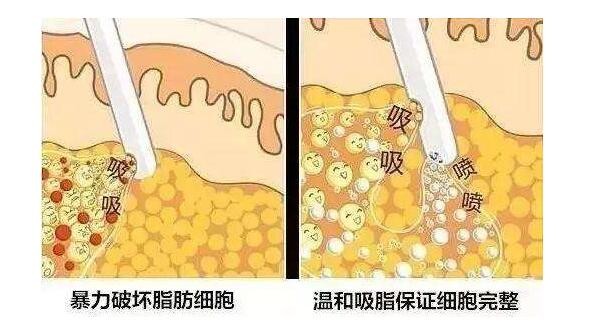 我脂肪填充了面部，想知道有没有什么副作用啊？